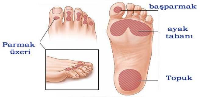 Diyabetik Ayak Belirtileri Nelerdir