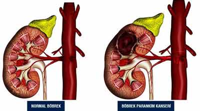 Böbrek Kanseri