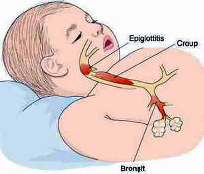 Bronşit Nedir