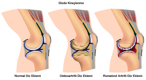 Eklem Ağrıları Tedavi Yöntemleri Nelerdir