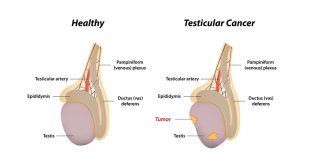 Testis Tümörü Nedir