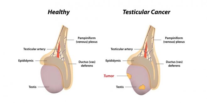 Testis Tümörü Nedir