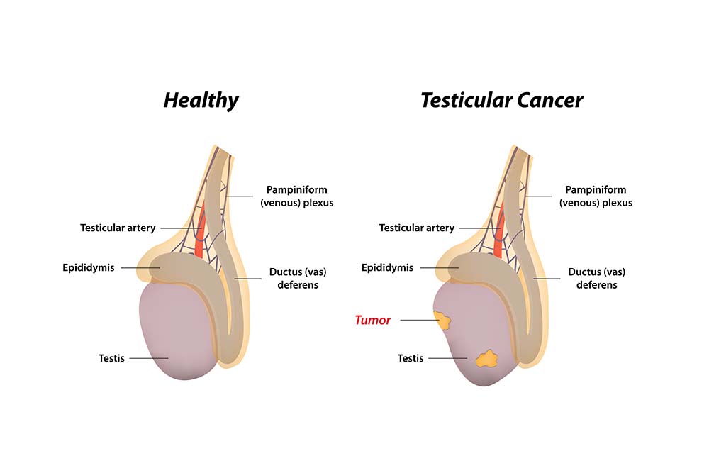 Testis Tümörü Nedir