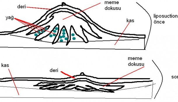 Erkeklerde Jinekomasti Hastalığı Riski