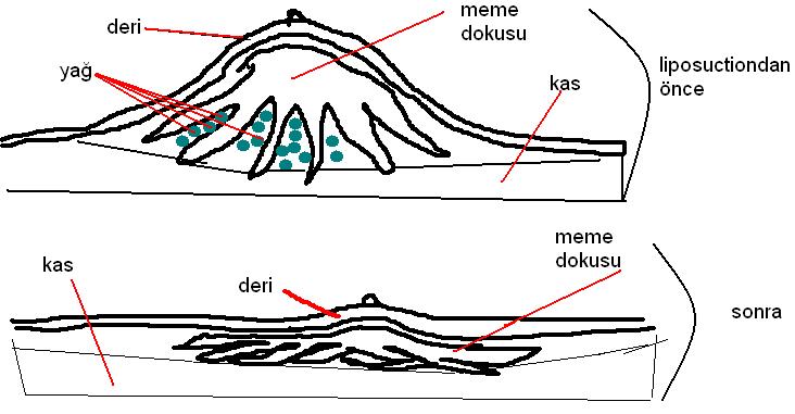 Erkeklerde Jinekomasti Hastalığı Riski