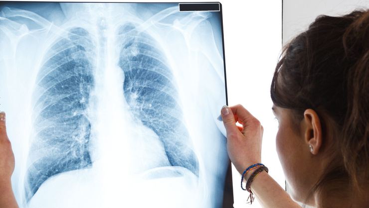 Akciğer Hastalıkları Belirtileri Nelerdir