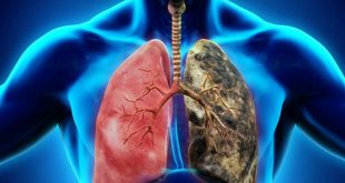 Akciğer Kanseri Hakkında Bilmeniz Gerekenler
