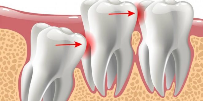 Diş Ağrısı En Çabuk Nasıl Geçer