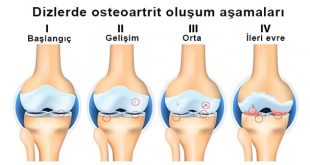 Dizde Kireçlenme Nedir