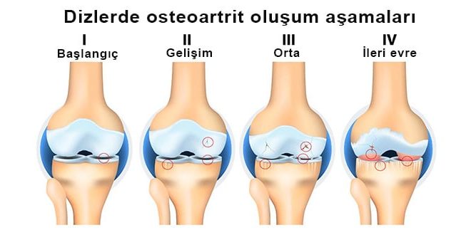 Dizde Kireçlenme Nedir