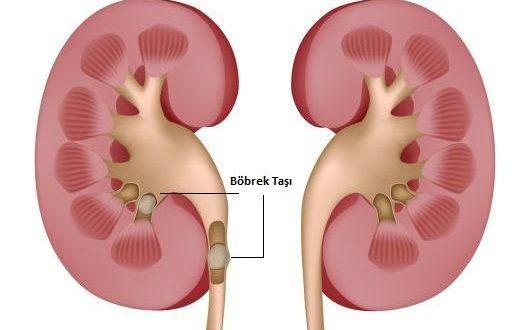 Böbrek Taşına Ne iyi Gelir