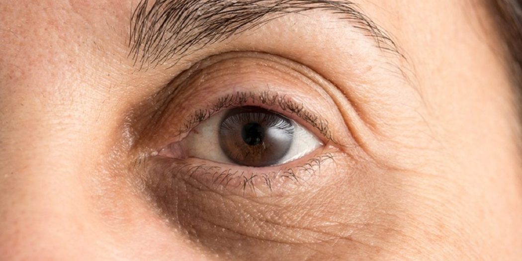 Göz Altı Morluklarına Ne iyi Gelir? Göz Altı Morlukları? - Nedir ve Nasıl