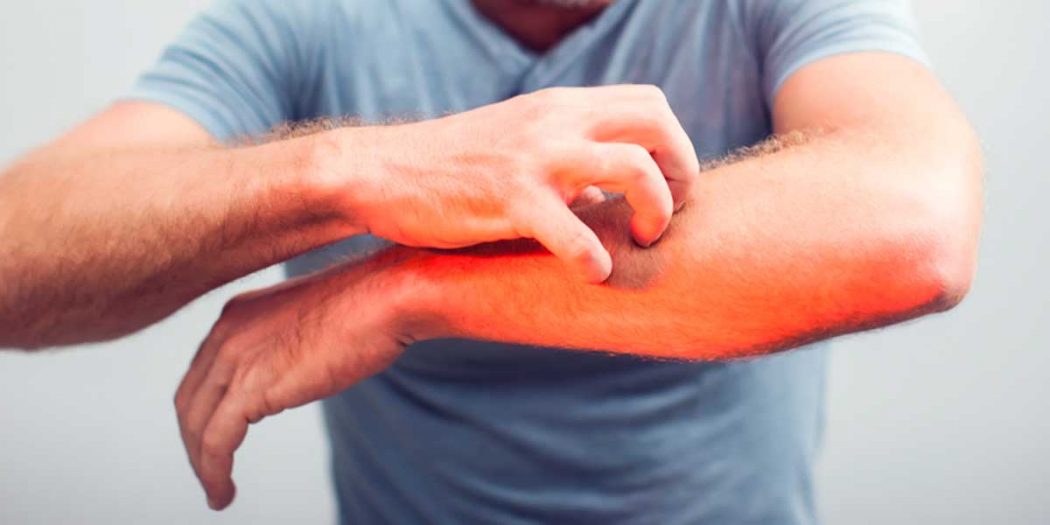 Kaşıntıya Ne iyi Gelir? Kaşıntı Nedir? Nedir ve Nasıl