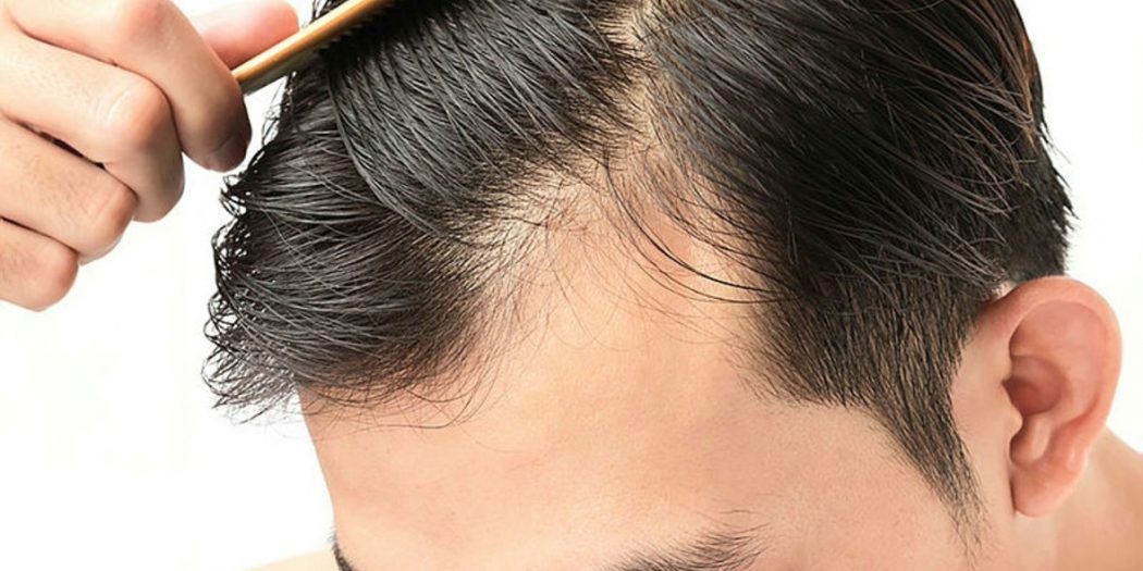 Saç Dökülmesine Ne iyi Gelir? Saç Dökülmesi Nedir? Nedir ve Nasıl